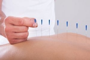 acucpunture